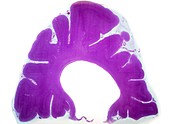 Alzheimer's brain,light micrograph