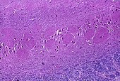 Alzheimer's brain,light micrograph