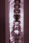 Spinal tumour,X-ray