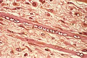 Muscle wasting in cancer,micrograph
