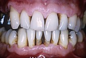 Receding gums in gum disease