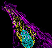 Bone cancer cell,light micrograph