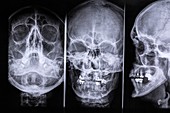 Paranasal sinuses,head X-rays