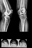 Diagnostic knee and knee-cap X-rays