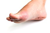 Gout of the big toe