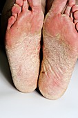 Eczema of the feet