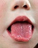 Tongue in scarlet fever