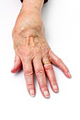 Rheumatoid arthritis of the wrist