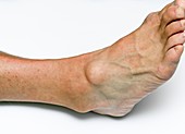 Ganglion cyst on ankle