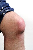 Prepatellar bursitis