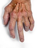 Rheumatoid arthritis of the hand