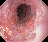 Oesophageal varices,endoscope view