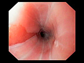 Abnormal oesophagus cells,endoscope view