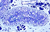 Human testis cancer,light micrograph