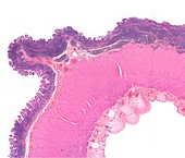 Human bowel lymphoma,light micrograph