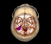 Brain tumour,3D CT scan