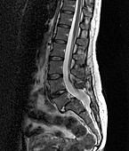 Spondylolisthesis,MRI