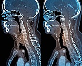 Osteoarthritis of the neck,CT scans