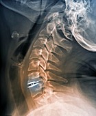 Spinal disc implant,X-ray