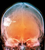 Brain blood vessel malformation,CT scan