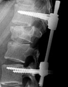 Pinned backbone,X-ray