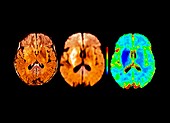 Brain in ischemic stroke,MRI