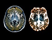 Brain in Creutzfeldt-Jakob disease,MRI