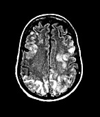 Brain in toxic encephalopathy,MRI