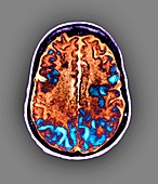 Brain in toxic encephalopathy,MRI