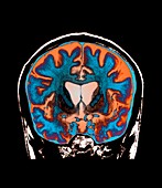 Brain in Huntington's disease,MRI