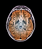 Brain in motor neurone disease,MRI