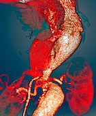 Arterial aneurysms in Marfan syndrome,CT