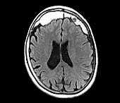 Excess skull growth,MRI