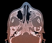 Bone damage in hyperparathyroidism,MRI