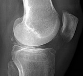 Calcification in the knee,X-ray