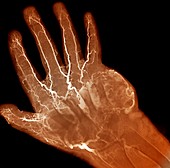 Hand tumour,X-ray