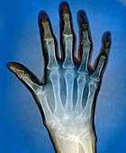Rheumatoid arthritis of the hand,X-ray