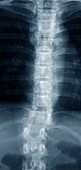 Spine in Pott's disease,X-ray