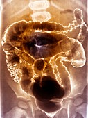 Intussusception of the intestines,X-ray