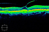 Epiretinal membrane,OCT scan