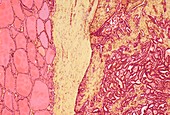 Thyroid cancer,light micrograph