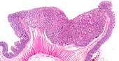 Bowel cancer,light micrograph