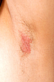 Flexural psoriasis of an armpit