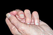 Dupuytren's contracture