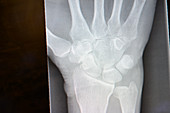 Wrist X-ray before trapeziumectomy