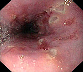 Oesophageal Crohn's disease,endoscopy