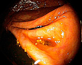 Healthy appendix,endoscopic view