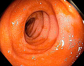 Normal terminal ileum,endoscopic view