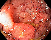 Cancer of the colon,endoscopic view