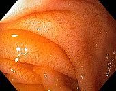 Normal duodenum,endoscopic view